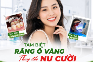 Tẩy trắng răng an toàn tại TP. Thủ Đức – Sở hữu nụ cười trắng sáng tự nhiên | Nha Khoa Trí Tâm