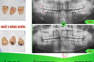 Nhổ Răng Khôn An Toàn – Giải Pháp Chấm Dứt Đau Nhức Kéo Dài