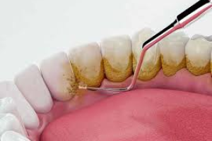 Cạo vôi răng có làm mòn răng không? Sự thật bạn cần biết trước khi quá muộn