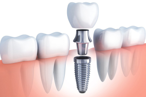 DỊCH VỤ TRỒNG RĂNG IMPLANT TẠI NHA KHOA TRÍ TÂM – GIẢI PHÁP PHỤC HÌNH RĂNG MẤT BỀN VỮNG, AN TOÀN LÂU DÀI