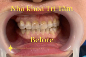 Dịch vụ cạo vôi răng uy tín ở Quận 2 – Giải pháp chăm sóc răng miệng tại Nha Khoa Trí Tâm