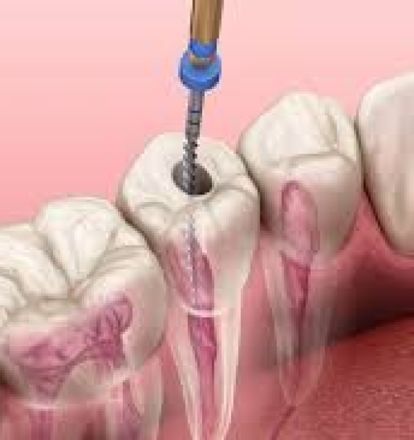 Điều Trị Tủy - Trám Kết Thúc 