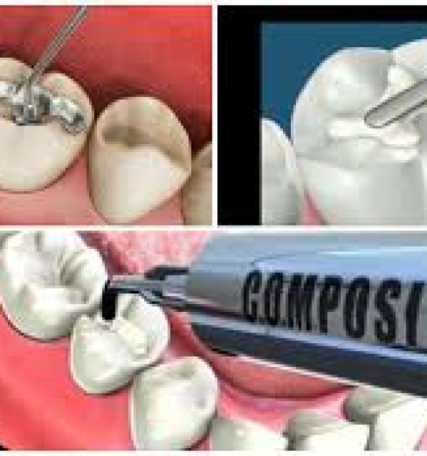 Trám Răng Vĩnh Viễn Bằng Composite 