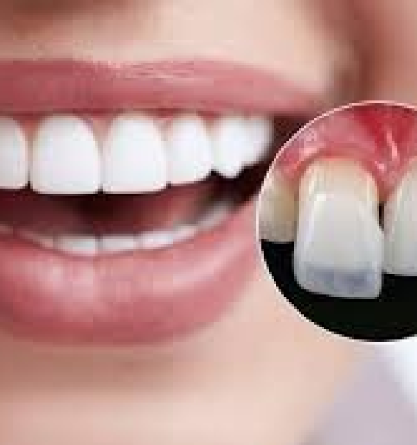 Răng sứ Veneer