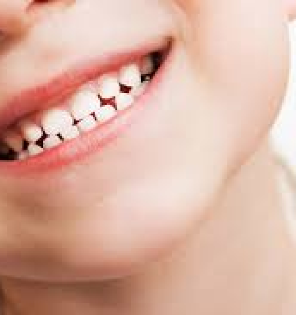 Trám răng sữa bằng Composite 