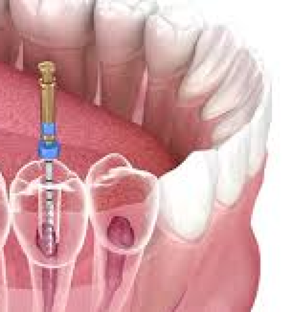 Điều Trị Tủy 1-2 Chân + Trám Kết Thúc 