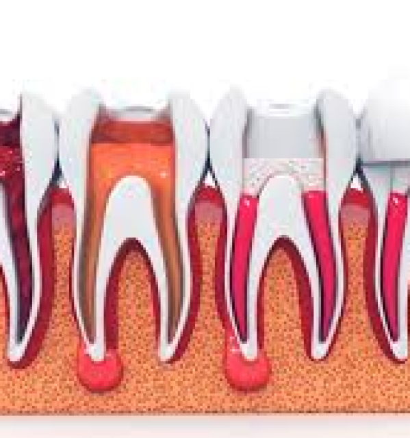 Điều Trị Tủy 3-4 Chân + Trám Kết Thúc 